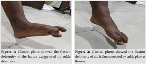 Figure 1 From Checkrein Deformity Of The Great Toe Managed By Midfoot