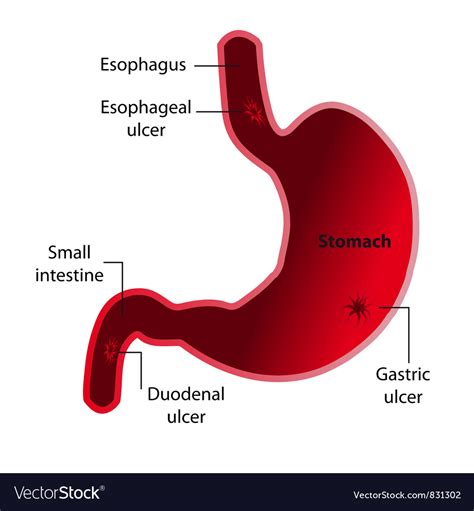 Gastric Ulcer Royalty Free Vector Image Vectorstock