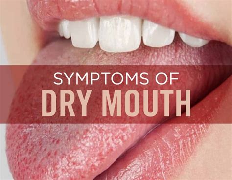 Dry Mouth Mouthwash: A Comprehensive Guide