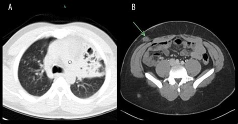 American Journal Of Case Reports Classical Presentation Of