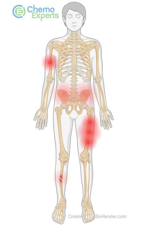 Bone Pain - ChemoExperts