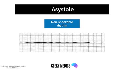 Shockable Vs Non Shockable Rhythms In Cardiac Arrest Geeky Medics