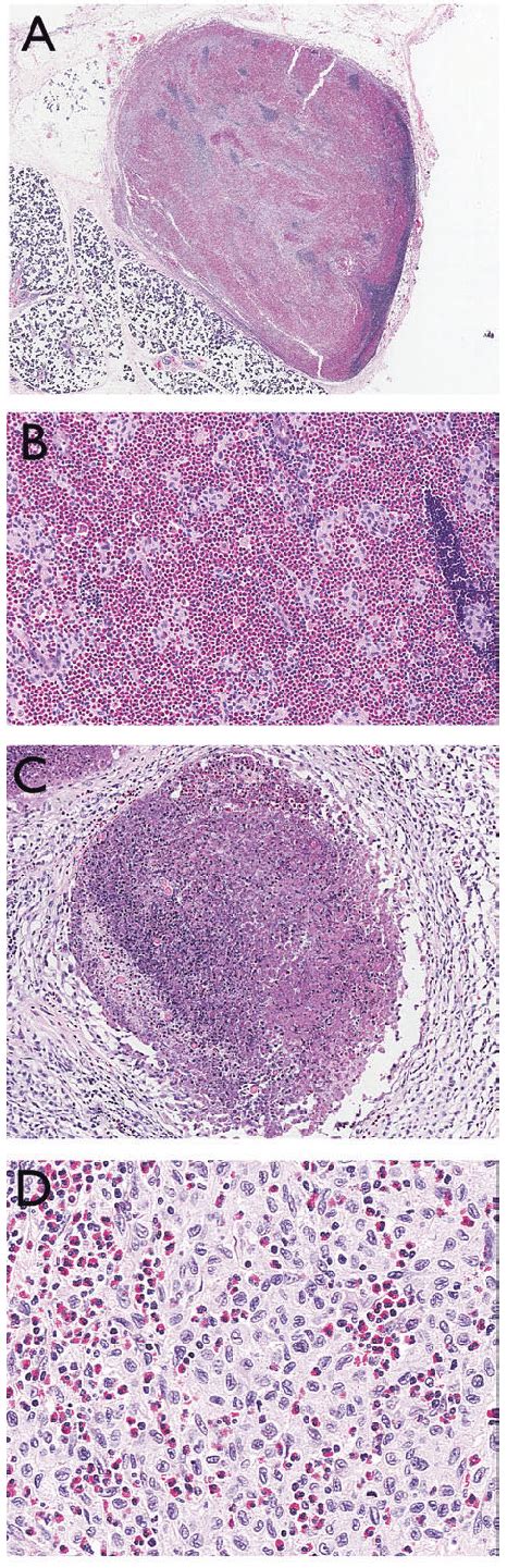 Low Power Hematoxylin And Eosin Showing One Of The Intraparotid Lymph