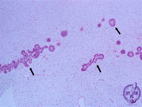 7oral Salivary Gland 5 Odontogenic Tumors Ameloblastic Fibroma