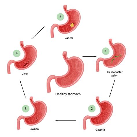 Stomach diseases. Diagram of diseases of helicobacter pylori, gastritis