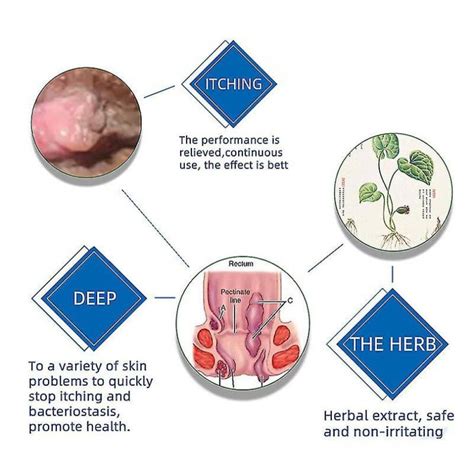Tib Herbal Hemorrhoid Cream Relieve Hemorrhoid Pain External Anal Fissure Treat Anal Bleeding