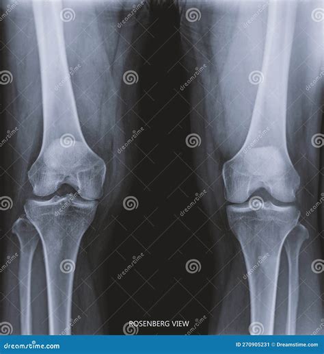 Film X Ray Both Knee Joint AP View Name Is Rosenberg View For Diagnosis