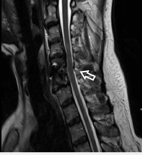 Magnetic Resonance Imaging Sagittal View Post Anterior Cervical