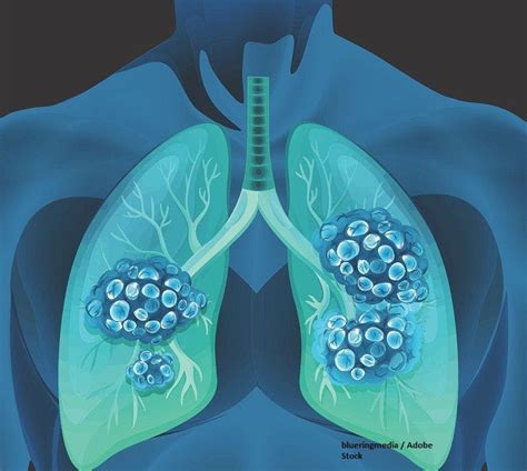 Cemiplimab/Chemo Receives Canadian Approval in Advanced NSCLC