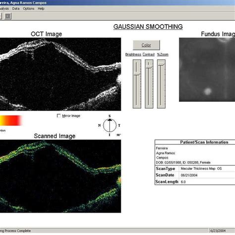 Optical Coherence Tomography (OCT) showing macular retinoschisis in ...