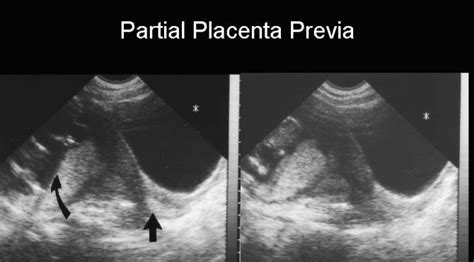 Classification of Placenta Previa