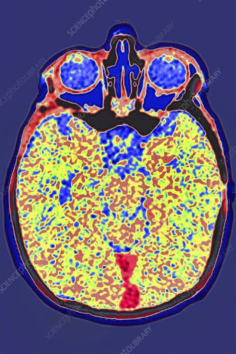 Cerebral Venous Thrombosis Ct Scan Stock Image C0555998 Science