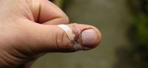 tetanus penyakit mematikan  luka info kesehatan
