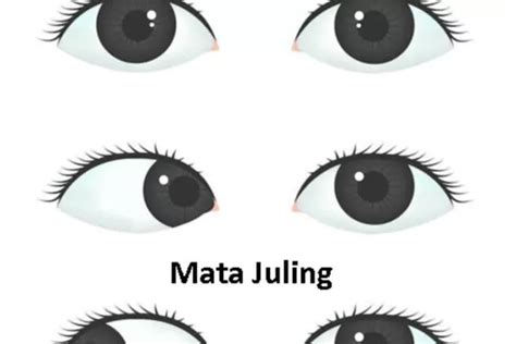 mata juling inilah penyebab   mengobati mata juling harian