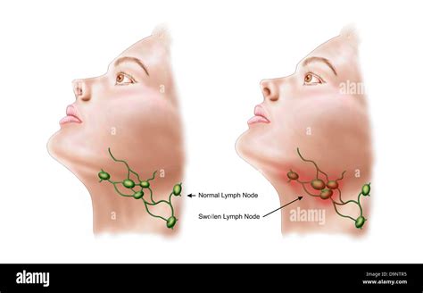 Neck lymph nodes hi-res stock photography and images - Alamy