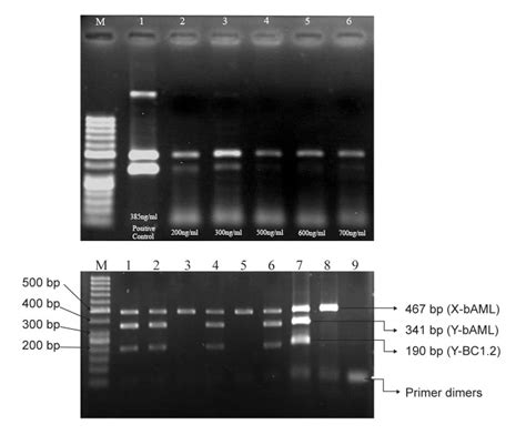 A Low Cost Efficient Multiplex PCR For Prenatal Sex Determination In