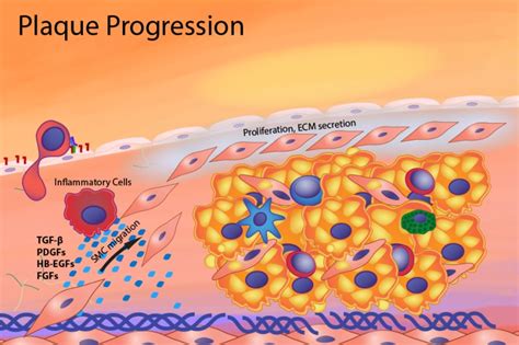 Figure Progression Of The Atherosclerotic Plaque Endotext