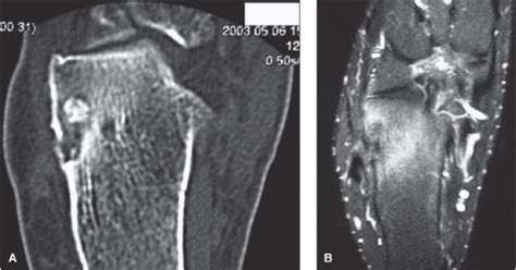 Calcaneal Spurs Radiology Key