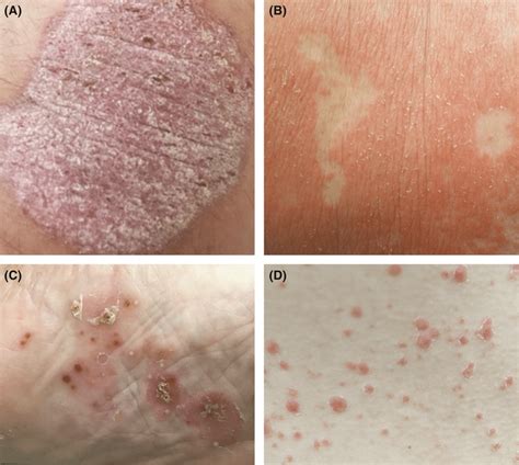 Paradoxical Psoriasis Phenotypes Include Plaque A Erythrodermic B Download Scientific