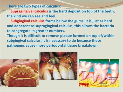 supragingival calculus formation | Chicago Criminal and Civil Defense