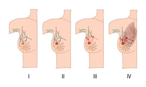 Breast Cancer Treatment By Stage & Cost in India - Denvax