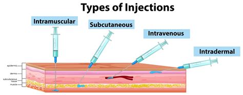 Best IV Injection Sites