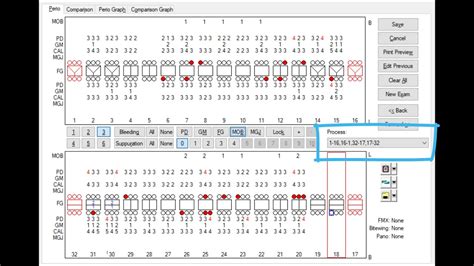 How To Do Periodontal Charting