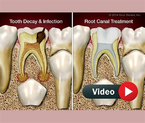 Pulpectomy Step By Step Procedure Access Preparation And