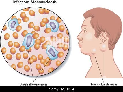 Les symptômes de la mononucléose infectieuse Vector illustration