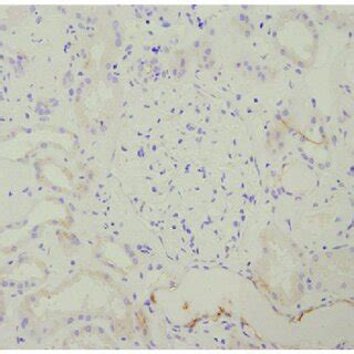 Glomerular and tubular epithelial cells positive for λ light chains