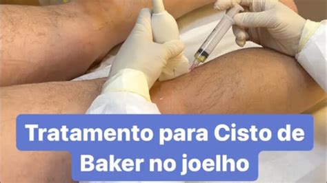 O Que É Bom Para Cisto - Remédios Eficazes Para Cisto de Baker | Actualizado julio 2026