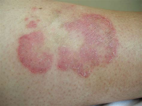 An Introduction To The Types Of Itchy Skin Rashes The