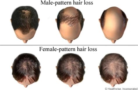 Male Pattern Alopecia Androgenetic Alopecia And Female Pattern Alopecia