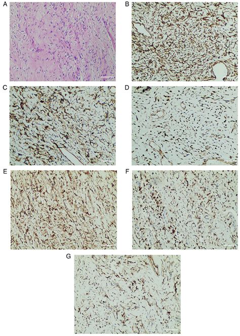 Pathology Following Surgery A Histopathology Results Demonstrating A