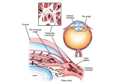 Angle Closure Glaucoma Or Narrow Angle Glaucoma Sri Eye Care