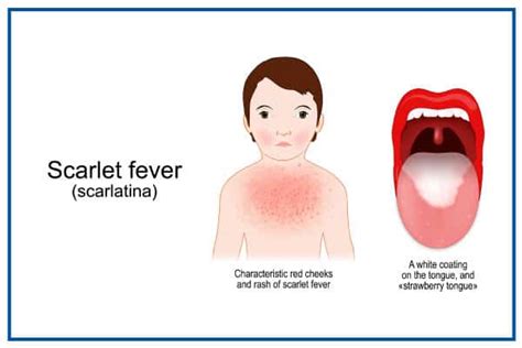 Scarlet fever symptoms – Costamedic