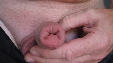 Swollen Cock After Nettles Treatment Oin Foreskin Gay Man Porn Xhamster