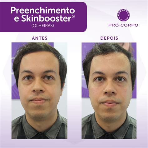 Skinbooster Antes E Depois Olheiras - Fotos de Antes e Depois: Resultados de nossos tratamentos | Pró-Corpo