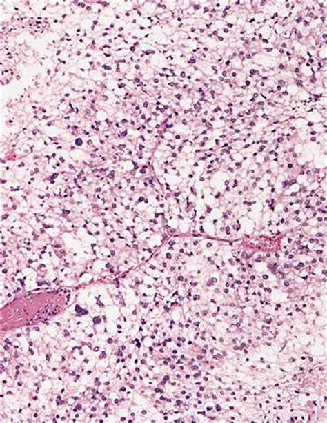 Pathology Outlines Pleomorphic Liposarcoma