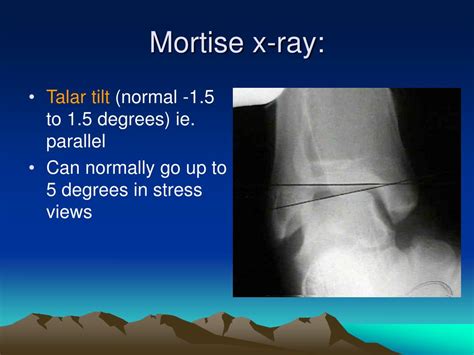 Ppt Foot And Ankle Fractures Powerpoint Presentation Id611999