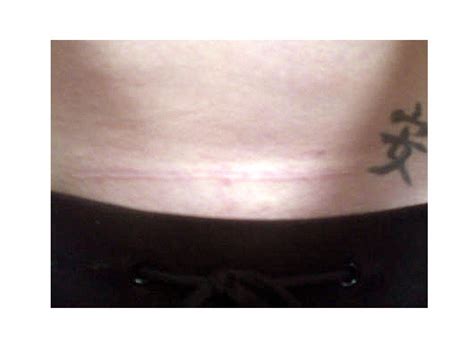 Caesarean section scars: photos - BabyCentre UK