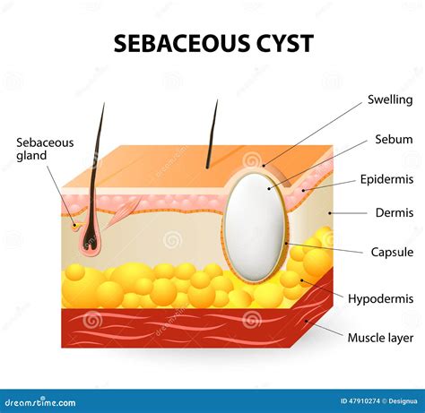 Sebaceous Cyst Cartoon Vector | CartoonDealer.com #30294829