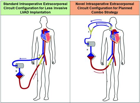 Schematic Representation Of The Standard Intraoperative Circuit For Cpb