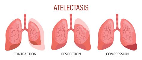 Atelectase Uma Doença Pulmonar Contracção Resorção Compressão