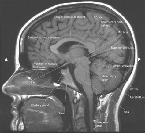 Introduction To Brain Imaging Radiology Key