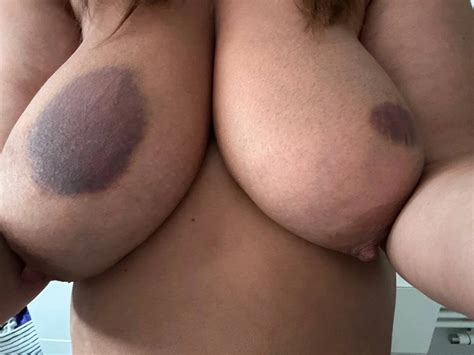 Meine Titten Zwei Tage Nach Dem Ficken Nude Pics Xhamster