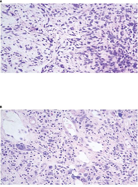 Frontiers Case Report Multimodal Neoadjuvant And Adjuvant