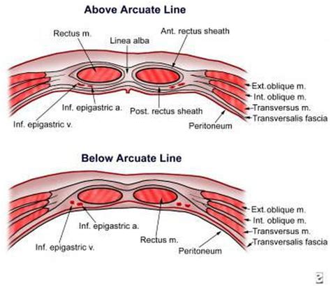 Rectus Sheath Hematoma Medizzy