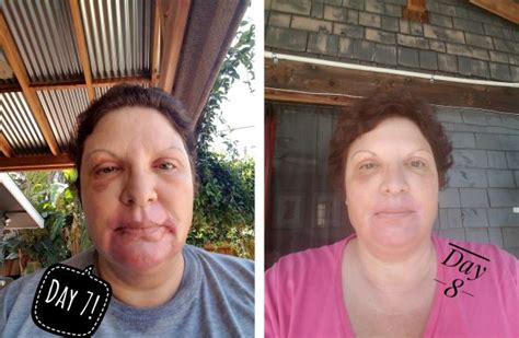 Plastic Surgery Recovery – A Patient's Journey in Pictures