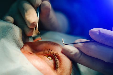 Cataract surgery doesn’t appear to increase the risk for AMD